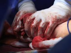 18 Principles Of Bleeding Control