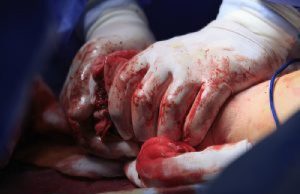 18 Principles Of Bleeding Control