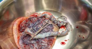 How To Deliver A Placenta After The Baby: Human Birth, Part 3