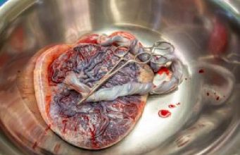 How To Deliver A Placenta After The Baby: Human Birth, Part 3