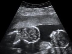 Twins and Breech Babies: Human Birth, Part 4