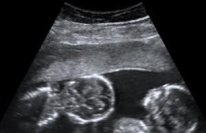 Twins and Breech Babies: Human Birth, Part 4