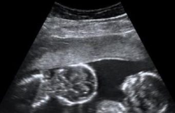 Twins and Breech Babies: Human Birth, Part 4